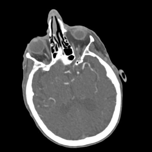 File:C2 fracture with vertebral artery dissection (Radiopaedia 37378-39200 A 242).png