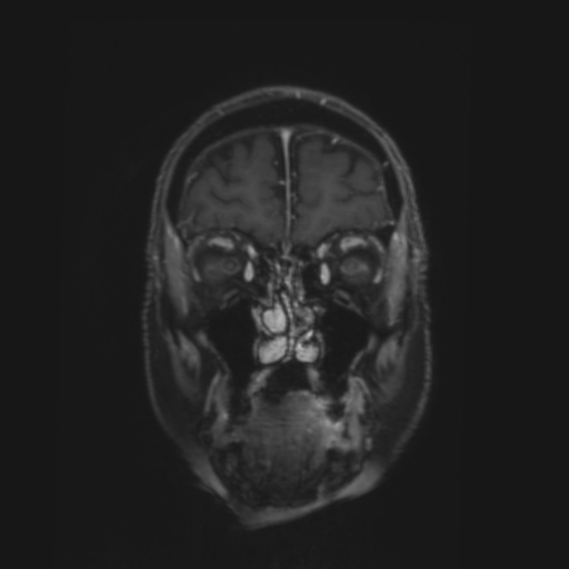File:CNS lymphoma with steroid response (Radiopaedia 37980-39921 Coronal T1 C+ 3).png