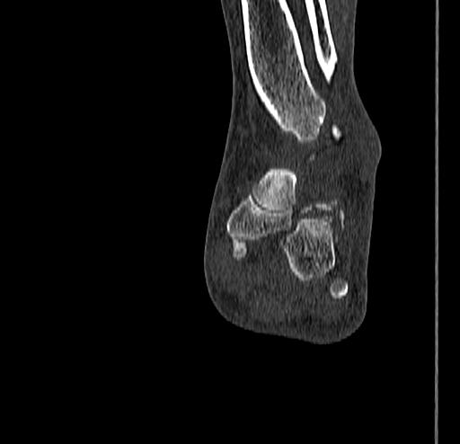 Calcaneal fracture - Sanders type 4 (Radiopaedia 90179-107370 Coronal bone window 56).jpg