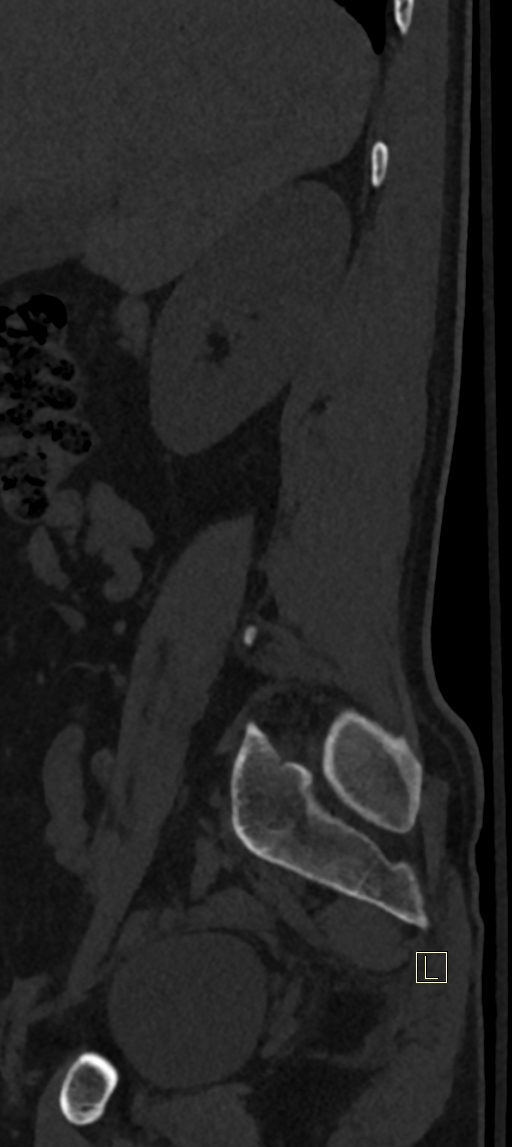 Calcaneal fractures with associated L2 burst fracture (Radiopaedia 71671-82493 Sagittal bone window 77).jpg