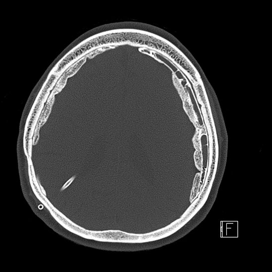 Calcified chronic subdural hematoma (Radiopaedia 77374-89492 Axial bone window 92).jpg