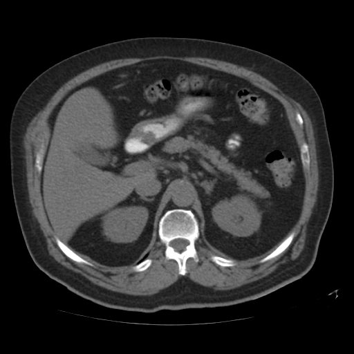 File:Calcified hepatic hydatid cyst (Radiopaedia 18907-18853 Axial non-contrast 18).jpg