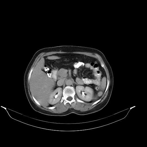 File:Calcified hydatid cyst of the liver (Radiopaedia 21212-21112 Axial C+ delayed 19).jpg