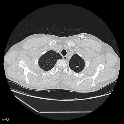 File:Calcified pulmonary metastases (Radiopaedia 32442).jpg