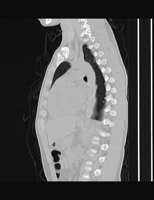 Calcifying pulmonary metastases (Radiopaedia 33359-34396 Sagittal lung window 30).jpg