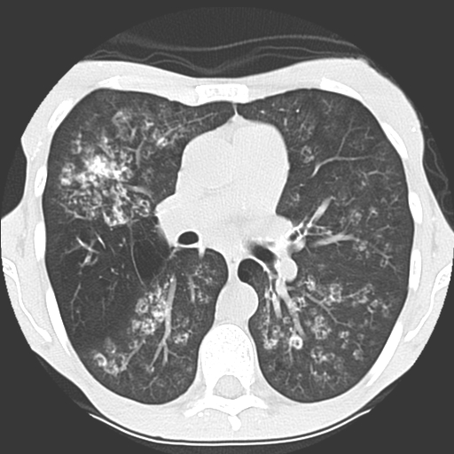 File:Calciphylaxis and metastatic pulmonary calcification (Radiopaedia 10887-11317 Axial lung window 20).jpg