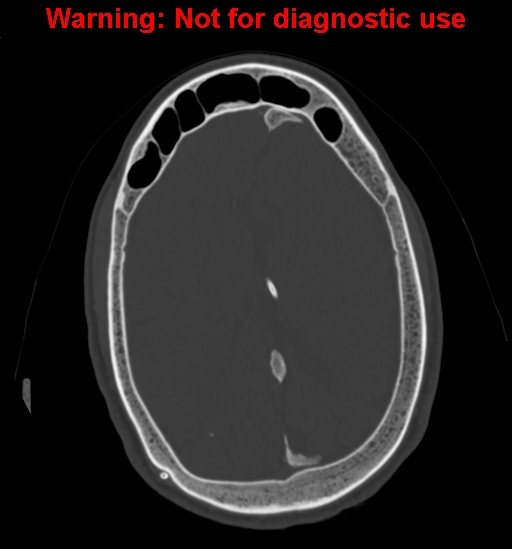 Calvarial thickening from chronic shunting (Radiopaedia 60079-67637 Axial bone window 118).jpg