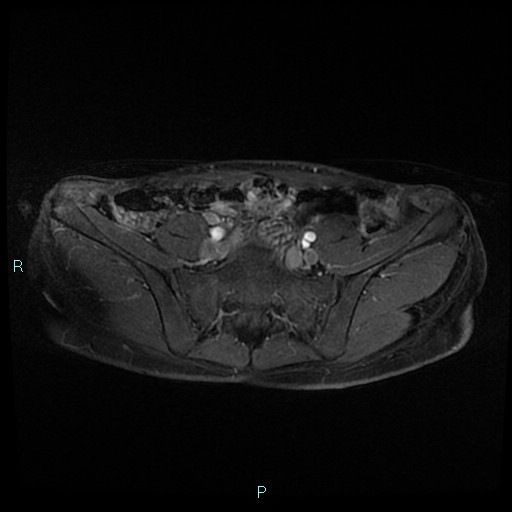 File:Canal of Nuck cyst (Radiopaedia 55074-61448 Axial T1 C+ fat sat 7).jpg