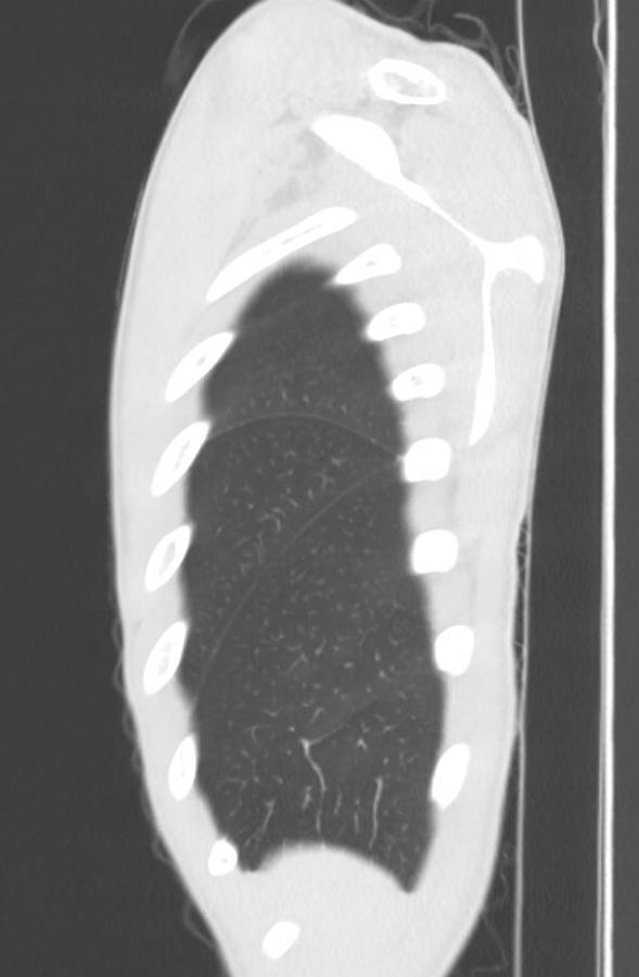 Cannabis-induced diffuse alveolar hemorrhage (Radiopaedia 89834-106946 Sagittal lung window 9).jpg