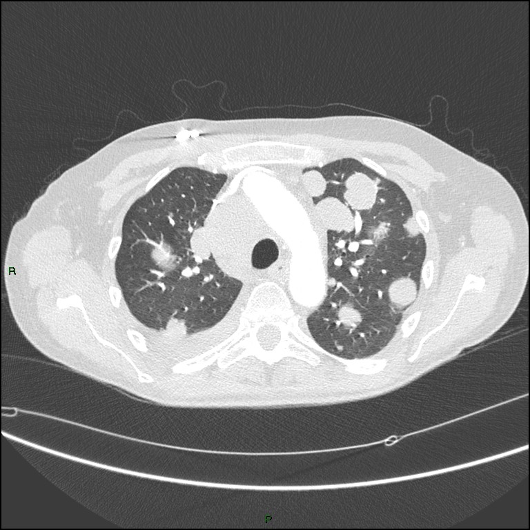 Cannonball metastases (Radiopaedia 82110-96150 Axial lung window 66).jpg