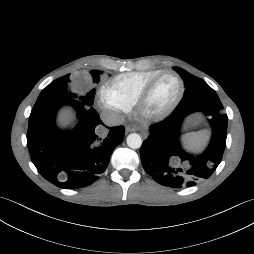 Cannonball metastases - testicular choriocarcinoma (Radiopaedia 84510-99891 B 85).jpg