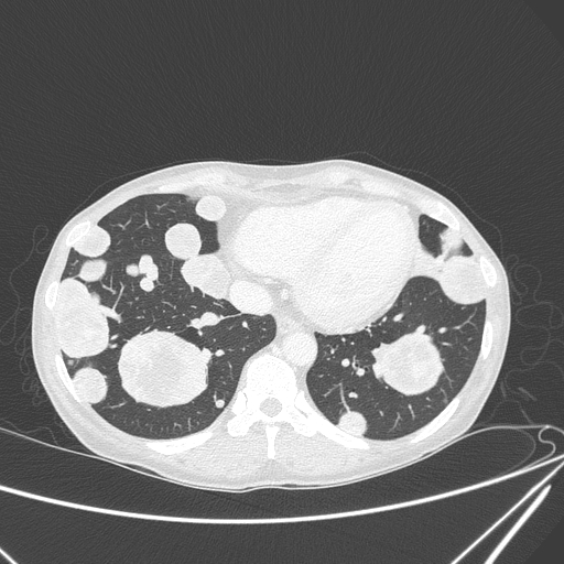 Canonball lung metastasis (Radiopaedia 77634-89837 Axial lung window 135).jpg