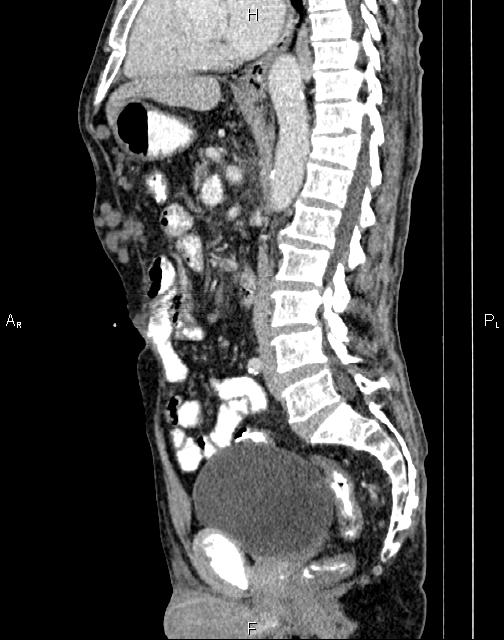 Caput medusae sign - portal hypertension (Radiopaedia 64007-72759 B 41).jpg