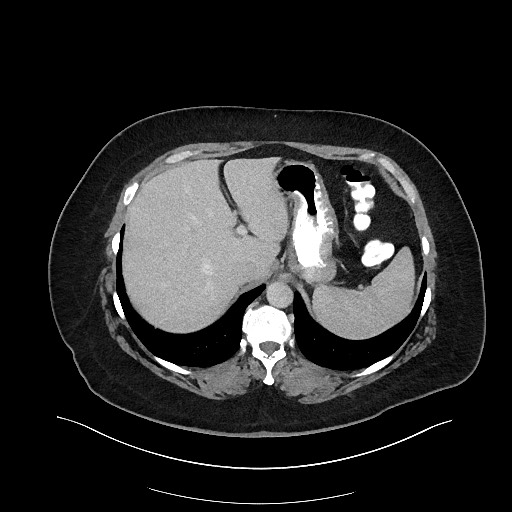 Carcinoid tumor - terminal ileum (Radiopaedia 60931-68739 A 26).jpg