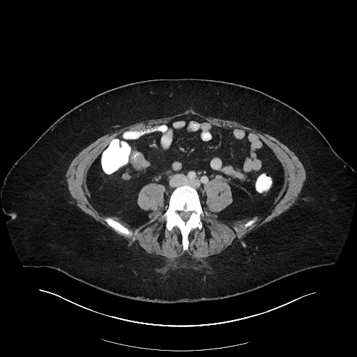 Carcinoid tumor - terminal ileum (Radiopaedia 60931-68739 A 83).jpg