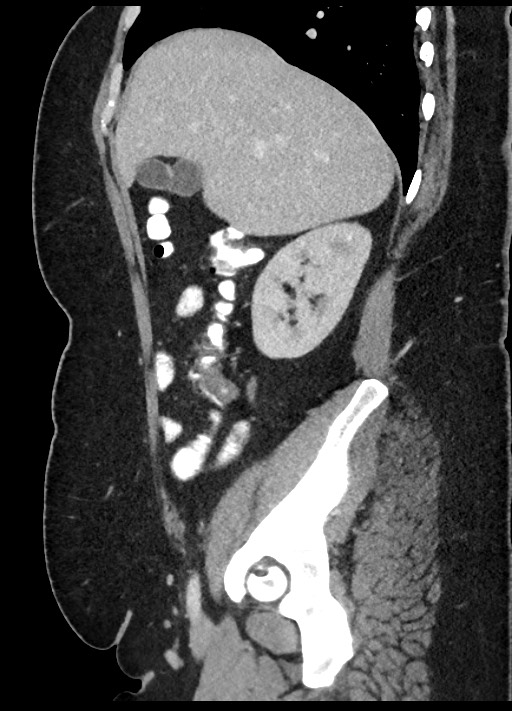 Carcinoid tumor - terminal ileum (Radiopaedia 60931-68739 C 74).jpg