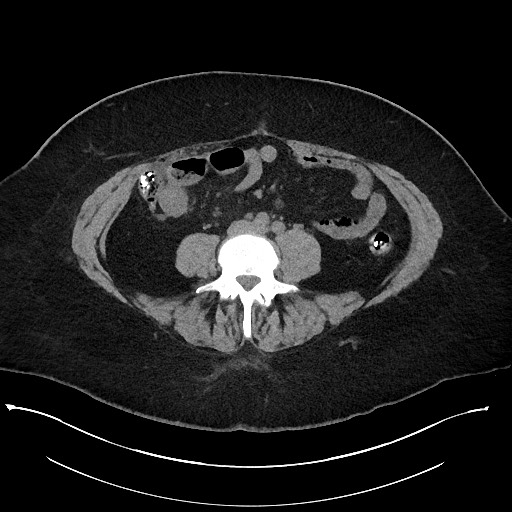 Carcinoid tumor - terminal ileum (Radiopaedia 60931-68740 Axial non-contrast 71).jpg