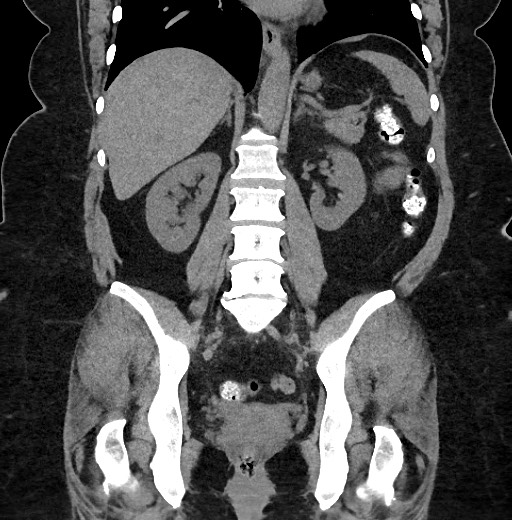 Carcinoid tumor - terminal ileum (Radiopaedia 60931-68740 Coronal non-contrast 68).jpg