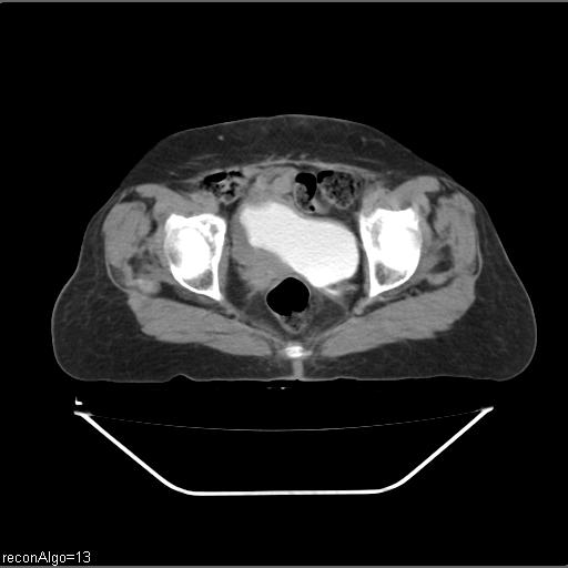 File:Carcinoma cervix- recurrence (Radiopaedia 34702-36137 B 86).jpg