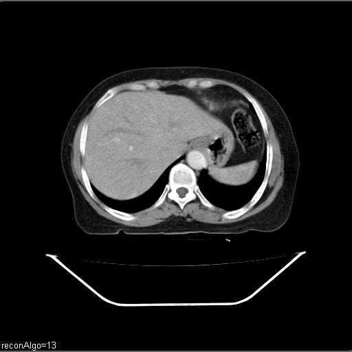 Carcinoma cervix- recurrence (Radiopaedia 34702-36137 B 9).jpg