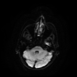 Carcinoma ex-pleomorphic adenoma of parotid (Radiopaedia 28383-28627 Ax DWI B-500 GE 63).jpg