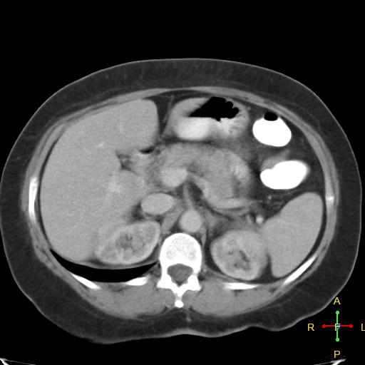 File:Carcinoma of sigmoid colon (Radiopaedia 23071-23100 B 6).jpg