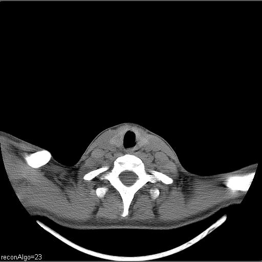 File:Carcinoma of the maxillary antrum (Radiopaedia 53805-59888 Axial non-contrast 13).jpg