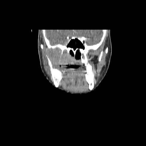 Carcinoma of the maxillary antrum (Radiopaedia 53805-59888 Coronal C+ delayed 60).jpg