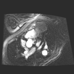 File:Cardiac fibroma (Radiopaedia 38974-41150 4 chamber FGRET 7).jpg