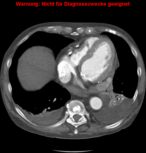 File:Cardiac perforation following transcatheter aortic valve implantation (Radiopaedia 23714-23863 A 11).png