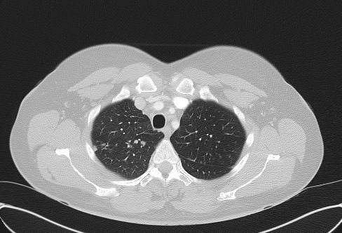 File:Cardiac sarcoidosis (Radiopaedia 74548-85534 Axial lung window 16).jpg
