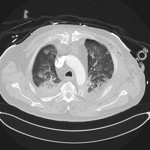Cardiac trauma (Radiopaedia 32874-33858 Axial lung window 16).jpg