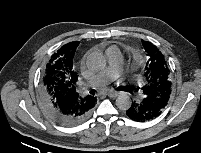 Cardiogenic pulmonary edema (Radiopaedia 68180-77678 Axial non-contrast 21).jpg