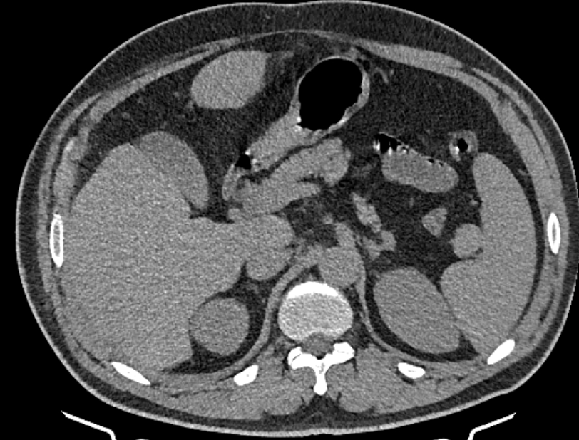 Cardiogenic pulmonary edema (Radiopaedia 68180-77678 Axial non-contrast 66).jpg