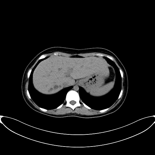 Caroli disease with medullary sponge kidney (Radiopaedia 82622-96804 Axial non-contrast 16).jpg