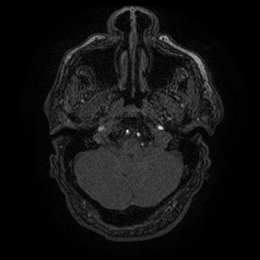 Carotid arterial dissection with acute cerebral infarction (Radiopaedia 26636-26784 MRA 149).jpg