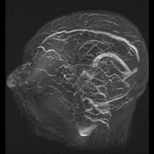 File:Carotid arterial dissection with acute cerebral infarction (Radiopaedia 26636-26784 MRV 6).jpg