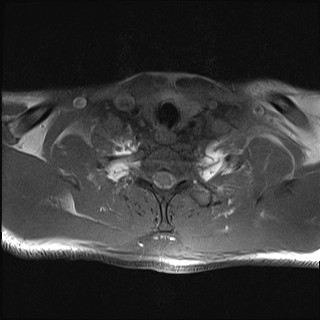 File:Carotid artery dissection (Radiopaedia 28441-28689 Axial T1 fat sat 7).jpg