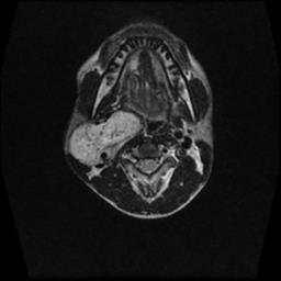 File:Carotid body tumor (Radiopaedia 30208-30823 Axial T2 10).jpg