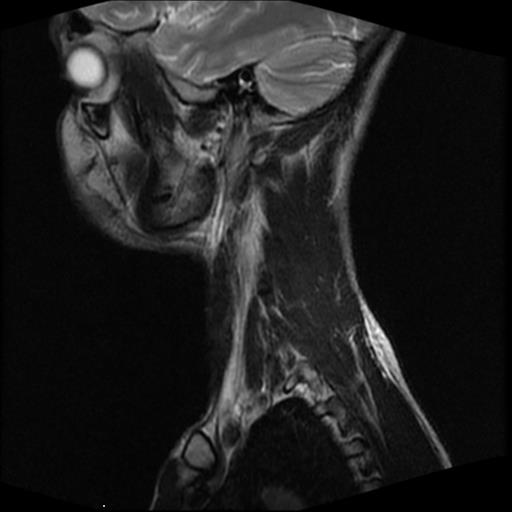 File:Carotid body tumor (Radiopaedia 30208-30823 Sagittal T2 5).jpg
