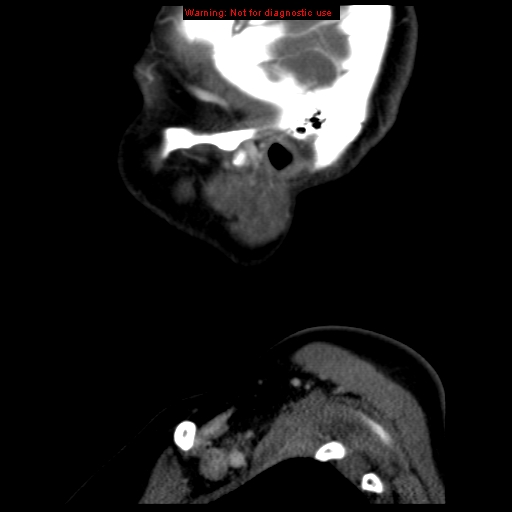 Carotid body tumor with lung metastases (Radiopaedia 9301-9986 Sagittal C+ delayed 2).jpg