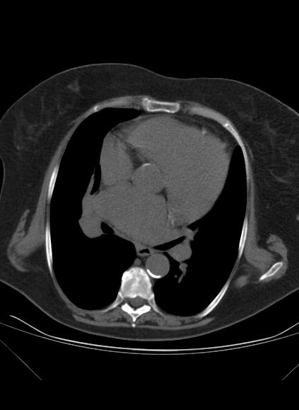 File:Caseous mitral annular calcification (Radiopaedia 61219-69122 Axial non-contrast 4).jpg