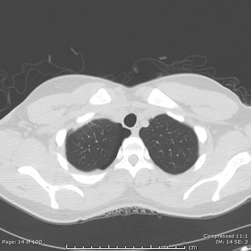 Catamenial pneumothorax (Radiopaedia 54382-60600 Axial non-contrast 14).jpg