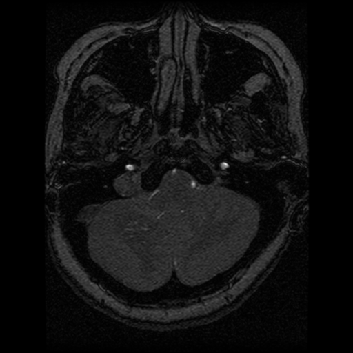 Cavernoma, DVA and right ICA aneurysm (Radiopaedia 33890-35072 E 95).png