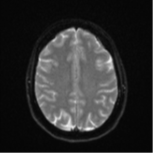File:Cavernoma with bleed - midbrain (Radiopaedia 54546-60774 Axial DWI 19).png