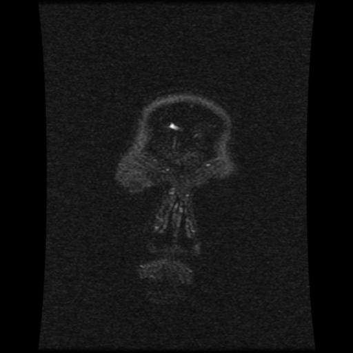 Cavernoma with developmental venous anomaly (Radiopaedia 22470-22507 MRV 121).jpg
