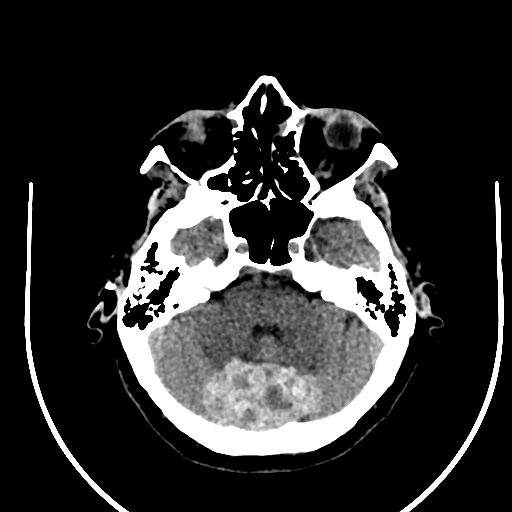 Cavernous hemangioma of the cerebellar falx (Radiopaedia 73025-83723 Axial non-contrast 35).jpg