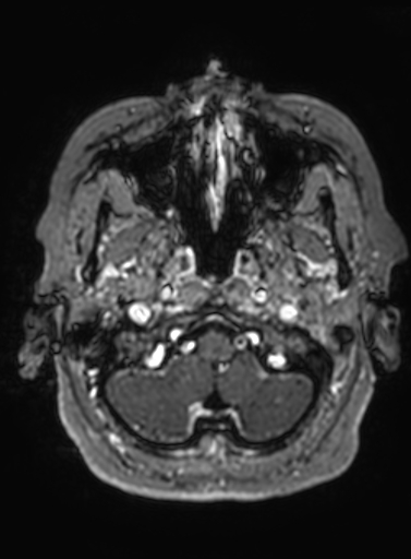 Cavernous hemangioma of the cerebellar falx (Radiopaedia 73025-83724 Axial T1 C+ 306).jpg