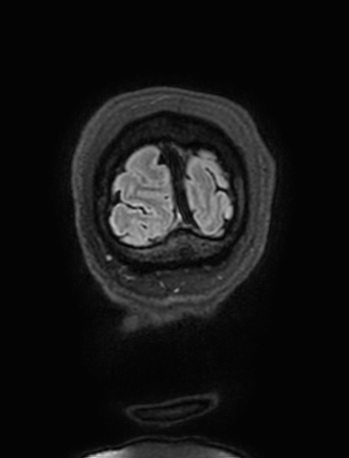 Cavernous hemangioma of the cerebellar falx (Radiopaedia 73025-83724 Coronal FLAIR 344).jpg