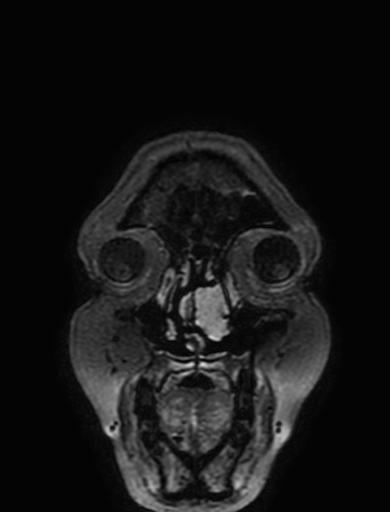 Cavernous hemangioma of the cerebellar falx (Radiopaedia 73025-83724 Coronal FLAIR 7).jpg